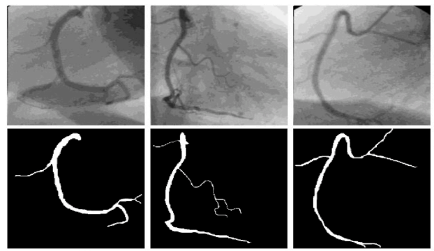 Coronary Artery Segmentation Using X-Ray Angiograms Project